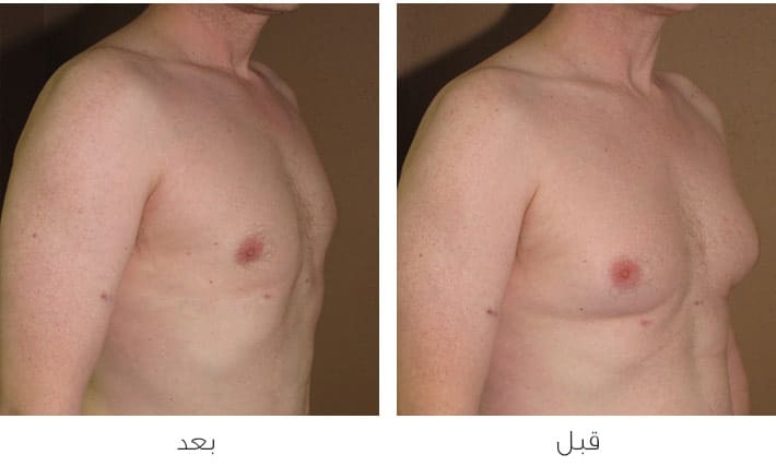 التطورات الحديثة في علاج التثدي لدى الرجال - عيادات ميدكا للجلدية والتجميل