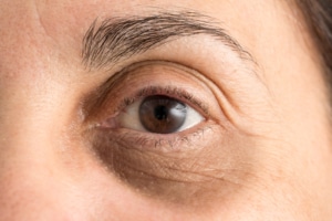 علاج الهالات السوداء وتجاعيد ما حول العين