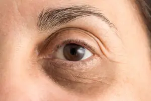 علاج الهالات السوداء وتجاعيد ما حول العين