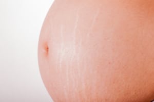 علاج التشققات الجلدية