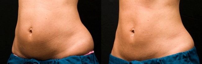 coolsculpting in riyadh