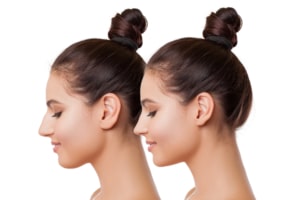 تجميل الأذن .. علاج جميع عيوب الأذن