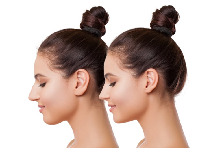 تجميل الأذن .. علاج جميع عيوب الأذن
