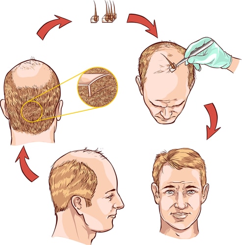 الطرق الحديثة لزراعة الشعر