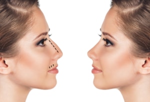 استخدام الخيوط التجميلية في الأنف