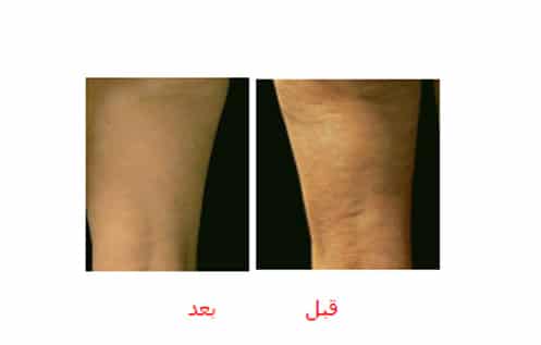 علاج السليولايت