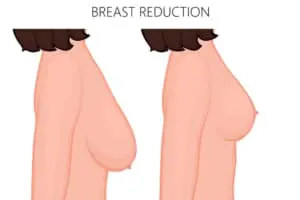 تجميل الثدي والحلمات