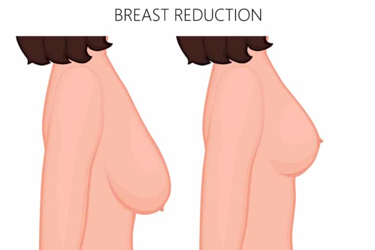 تجميل الثدي والحلمات