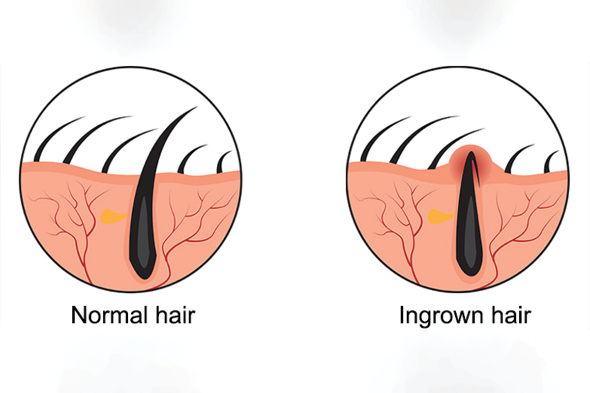 طرق إزالة الشعر تحت الجلد