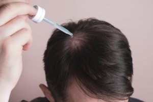 المينوكسيديل ( Minoxidil ) للشعر