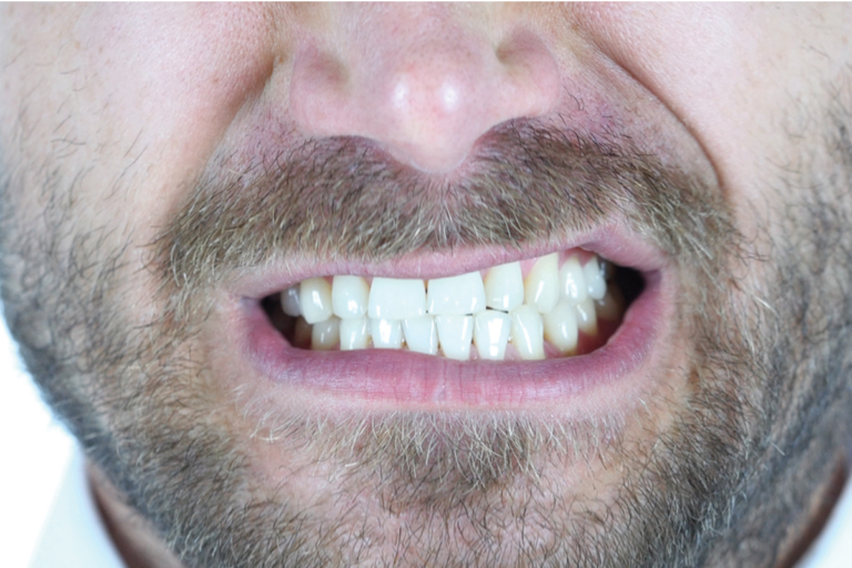 علاج صرير الأسنان بالبوتكس