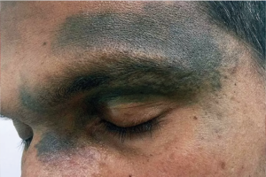 وحمة أوتا Nevus of Ota