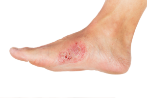 القرح الجلدية Skin Ulcers
