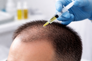 تقنية الاكسوسمارت Exosome Hair