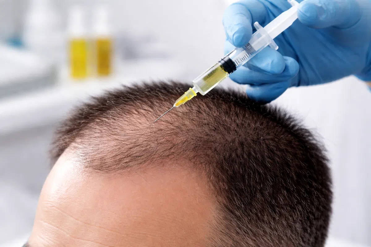 تقنية الاكسوسمارت Exosome Hair