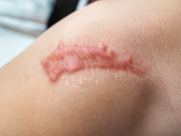 ما هي أسباب الندبات؟