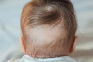 تساقط الشعر لدى الأطفال