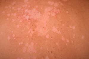 التينيا الملونة Tinea versicolor