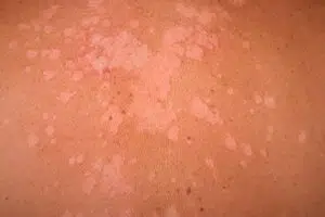 التينيا الملونة Tinea versicolor