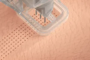 Micro-Coring Technology