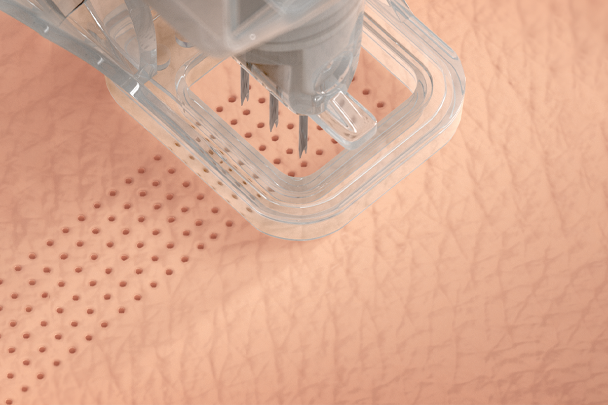 Micro-Coring Technology