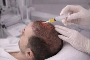 تقوية بصيلات الشعر بعد زراعة الشعر| كيف تحافظ على النتائج وتزيد كثافة الشعر؟