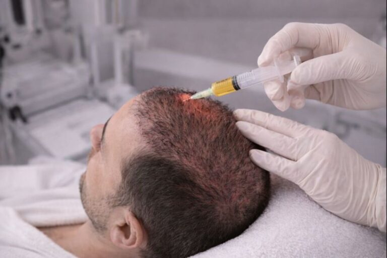 تقوية بصيلات الشعر بعد زراعة الشعر| كيف تحافظ على النتائج وتزيد كثافة الشعر؟