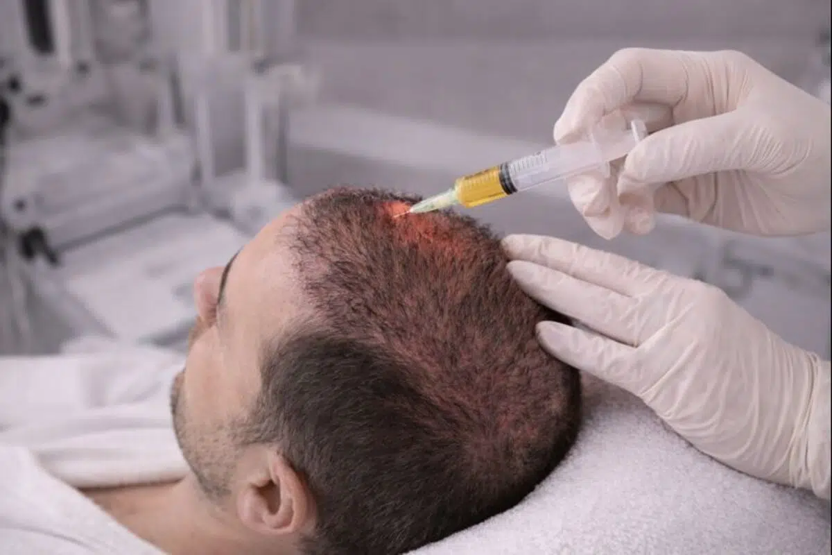 تقوية بصيلات الشعر بعد زراعة الشعر| كيف تحافظ على النتائج وتزيد كثافة الشعر؟