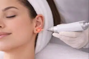 Best laser for ear piercing hole closure