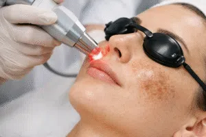 علاج تصبغات الوجه