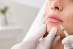 Lip Filler Dissolving with Hyaluronidase
