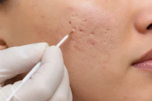 TCA CROSS لعلاج حفر الوجه وندبات حب الشباب العميقة