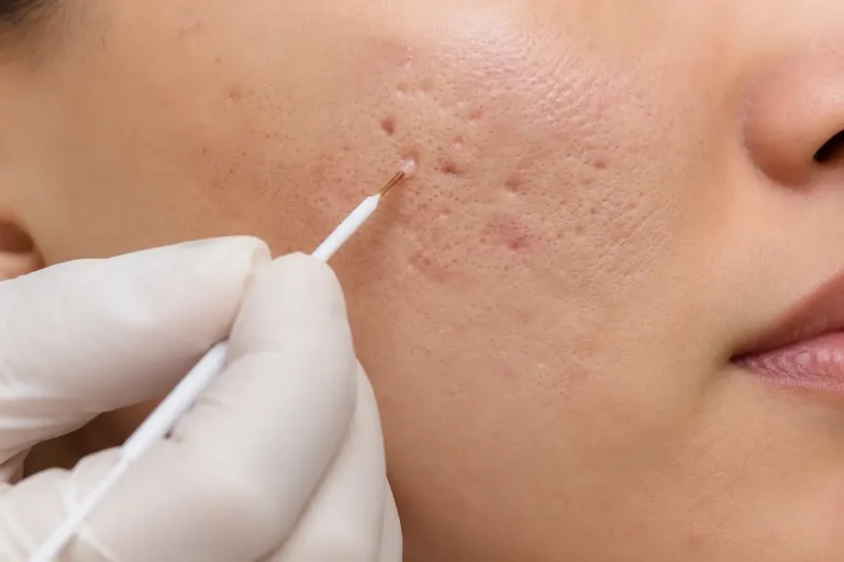 TCA CROSS لعلاج حفر الوجه وندبات حب الشباب العميقة